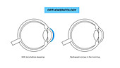 Orthokeratology contact lens, illustration