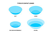 Types of contact lenses, illustration