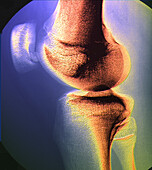 Knee disease, X-ray