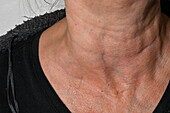 Swollen lymph nodes in patient with high grade B cell lymphoma