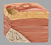 Stage 2 bedsore, illustration