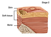 Stage 2 bedsore, illustration