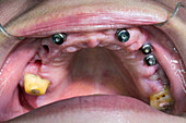 Dental implants