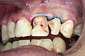 Root canal dental surgery