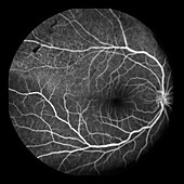 Retinoschisis, angiogram
