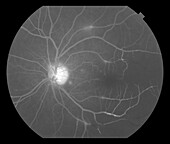 Hemispheric retinal artery occlusion, angiogram