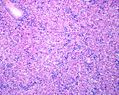 Erythroblastosis fetalis, light micrograph