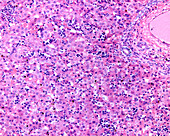 Erythroblastosis fetalis, light micrograph