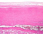 Dissecting aneurysm, light micrograph