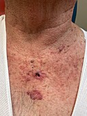 Nodular basal cell carcinoma