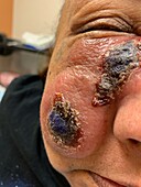 Cutaneous T cell lymphoma