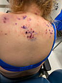 Skin picking disorder