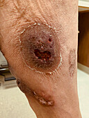 Pyoderma gangrenosum after diverticulitis surgery