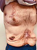 Pyoderma gangrenosum after diverticulitis surgery
