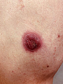 Pyoderma gangrenosum after diverticulitis surgery