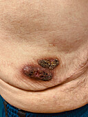 Pyoderma gangrenosum after diverticulitis surgery