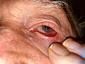 Squamous cell carcinoma of the conjunctiva