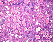 Chronic thyroiditis, light micrograph
