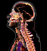 Atherosclerosis, 3D CT scan