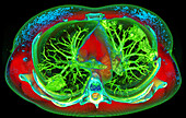 Lungs affected by Covid-19 pneumonia, 3D CT scan