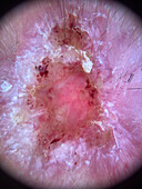 Basal cell carcinoma, dermoscopy