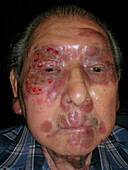 Cutaneous T cell lymphoma