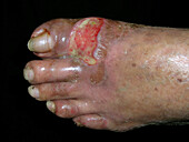 Cutaneous T cell lymphoma