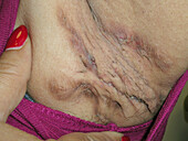 Hidradenitis suppurativa