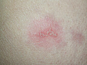 Genital herpes infection