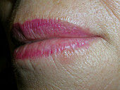 Oral herpes infection