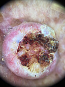 Keratoacanthoma, dermoscopy