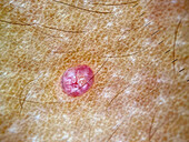 Molluscum contagiosum, dermoscopy