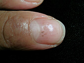 Pitted nail due to severe atopic dermatitis