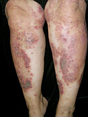 Psoriasis during treatment