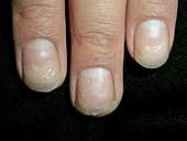 Psoriasis during treatment