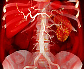 Renal artery thrombosis, 3D CT scan