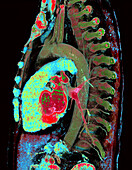 Healthy mediastinum, 3D CT scan