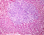 Human liver cholangiocarcinoma, light micrograph