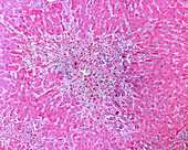 Toxic liver disease, light micrograph