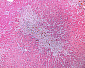 Toxic liver disease, light micrograph