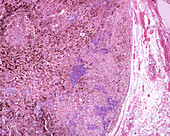 Metastasis of malignant melanoma, light micrograph
