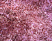 Metastasis of malignant melanoma, light micrograph