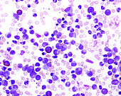 Chronic myeloid leukaemia, light micrograph