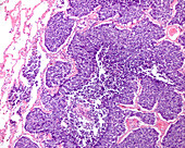 Small cell lung carcinoma, light micrograph