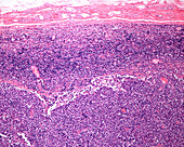 Reticulosarcoma of the lymph node, light micrograph