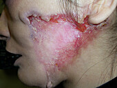 Pyoderma gangrenosum treated with infliximab