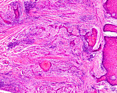 Epidermoid carcinoma of the tongue, light micrograph
