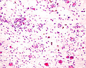 Chronic inflammation in connective tissue, light micrograph