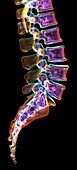Lumbar and sacral spine, 3D CT scan