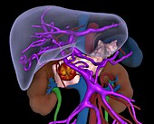 Pancreatic cancer, 3D CT scan